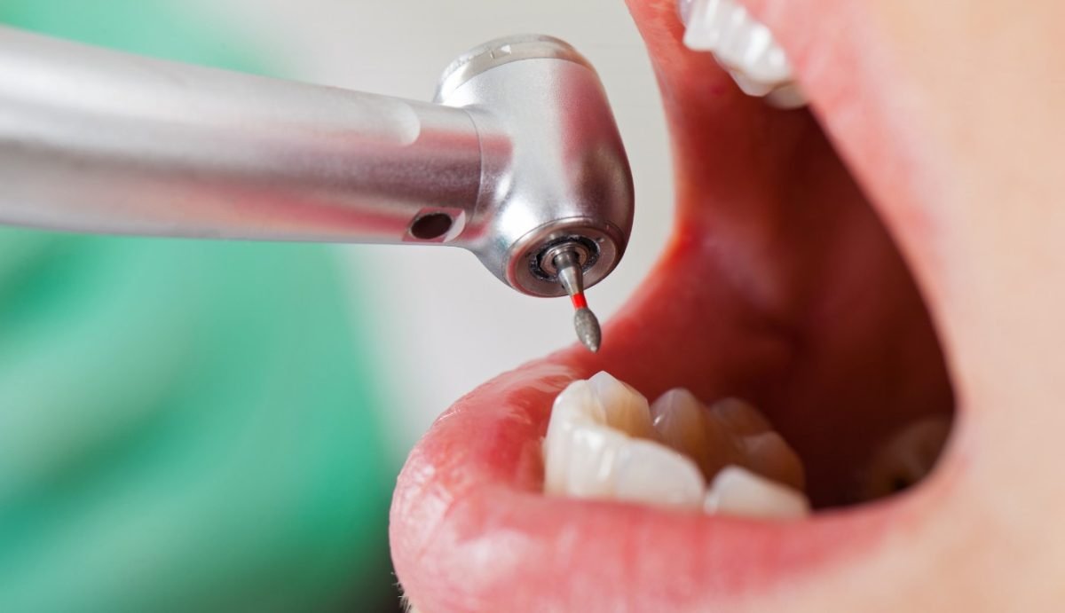 Read more about the article Everything You Need to Know About Dental Restorations