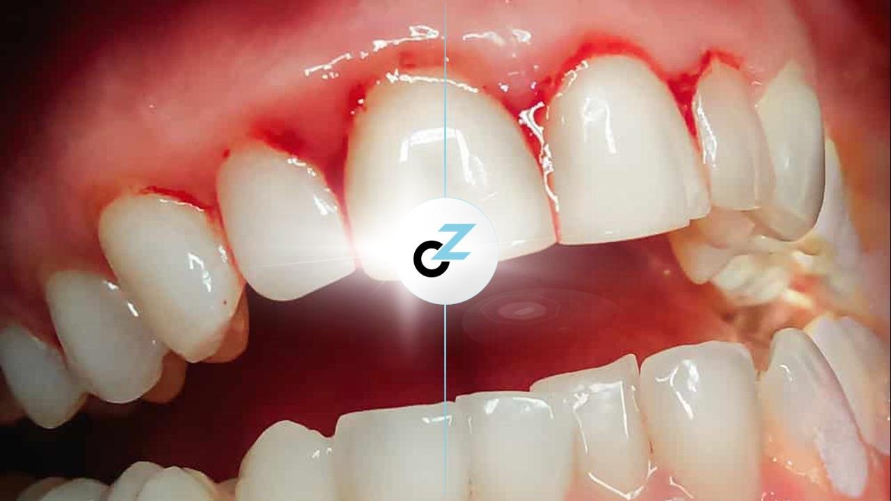 Read more about the article Gingivitis and dental problems